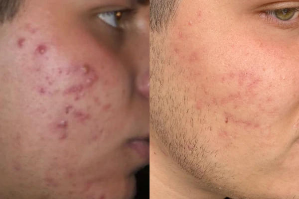 Facial skin condition