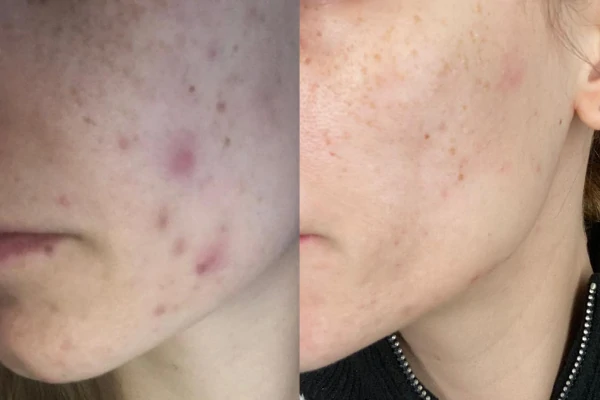 Facial skin condition