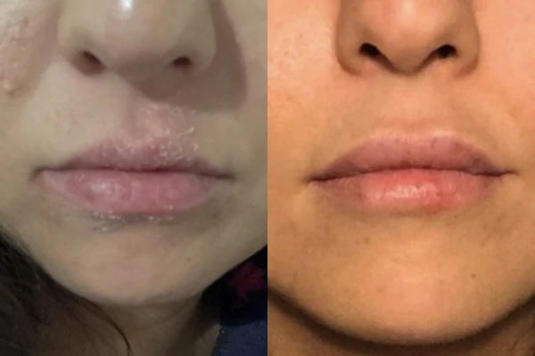 Before and after of dry skin