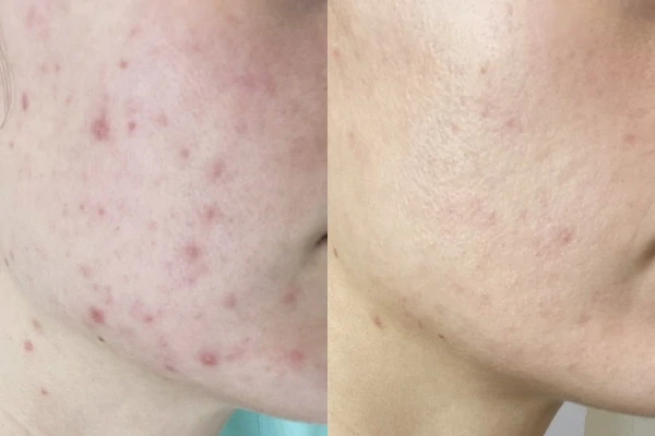 Before and after of Acne and redness