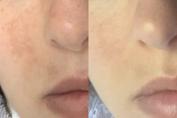Before and after of Melasma