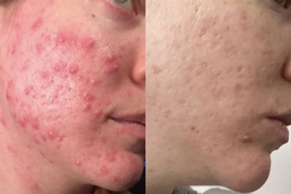 Before and after of Cystic Acne