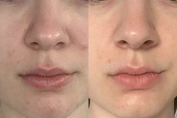 Before and after of Acne