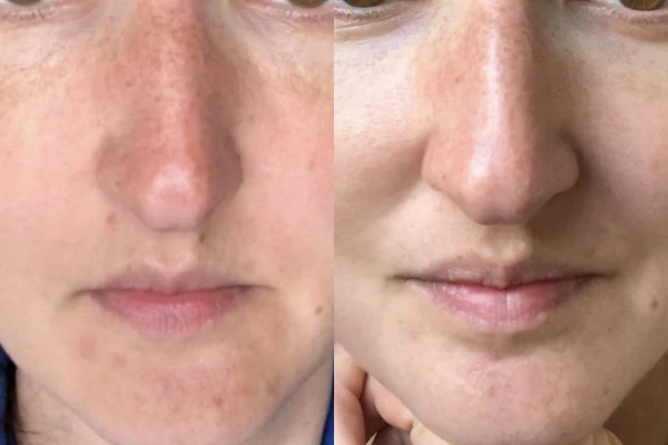 Before and after of Acne scarring