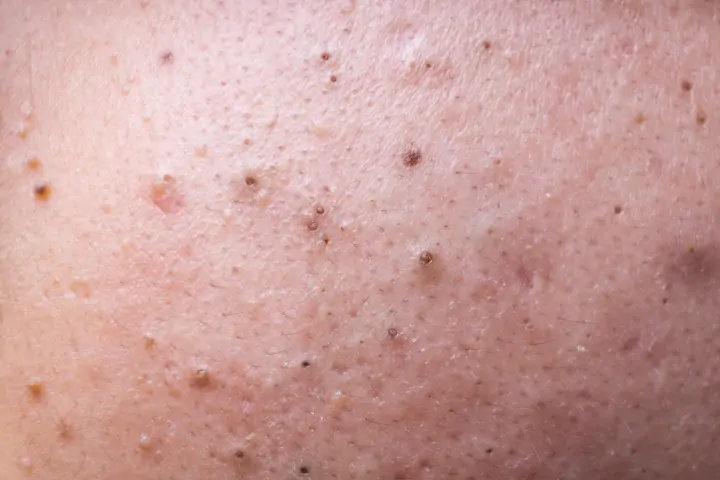Blackheads