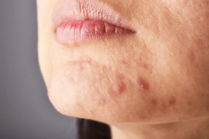 Cysts and Nodules