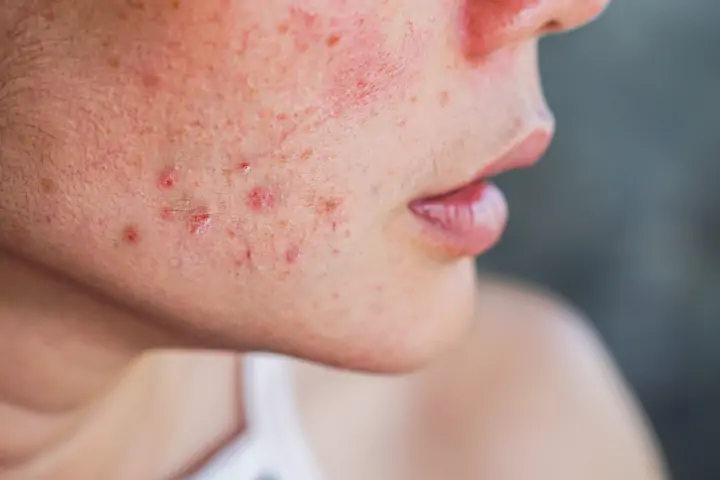 Papules and Pustules