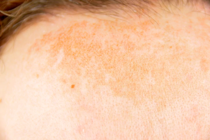 Age spots